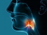 Throat Cancer: Signs and Symptoms