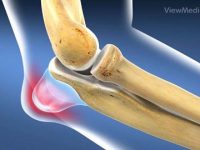 An Overview of Elbow Bursitis
