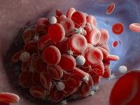 New research finds microclotting and inflammatory molecule abnormalities in long-COVID
