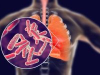 Tuberculosis: Symptoms, Causes & Cure