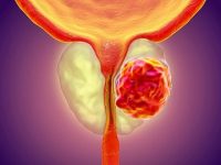 Symptoms of prostate cancer