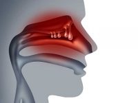 The Connection Between Nasal Polyps and Sinus Infections