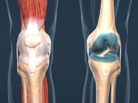 6 Foods to Avoid If You Have Arthritis or Joint Pain