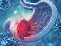 Sedentary Lifestyle Leading To Gastric Cancer