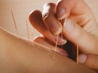 How Acupuncture Can Improve Your Health?