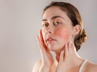 Understanding the Symptoms of Rosacea