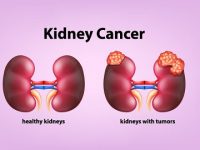 How Advanced Kidney Cancer Spreads