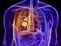Types of Lung Cancer: Knowing the Differences and Treatment Options