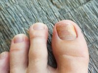 Dealing with thick, discolored toenails