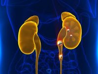 Kidney Stones in Children: What to Know