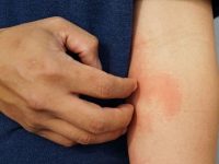 What Is Asteatotic Eczema?