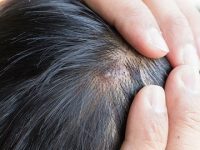 Tired of itchy acne on your scalp? Here’s what can help