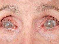 Diabetes Can Age the Eye by 30 Years, Finds Protein Study