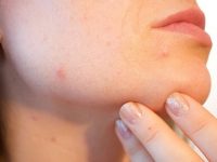 Decoding hormonal acne