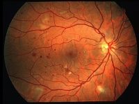 Preventing Vision Loss in Diabetes: 9 Fundamental Tips To Protect Your Eyesight