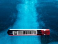 New blood test may help better detect early stage lung cancer