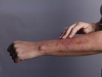 Similarities, Differences, and the Link Between Eczema and Lymphoma