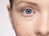 Eczema Around the Eyes: What to Know