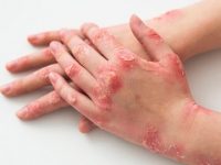 8 skin problems that can be caused by Diabetes